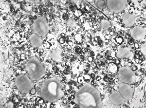 F,68y. | xanthomatous cell in atherosclerotic plaque - a. vertebralis